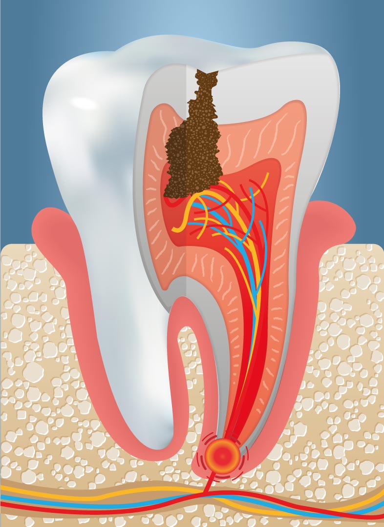 illustrazione del dente cariato
