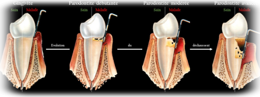 illustrazione del meccanismo di evoluzione della parodontite